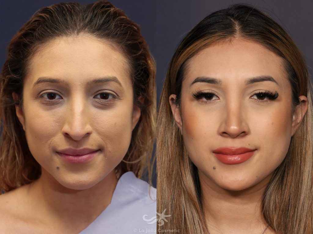Rhinoplasty: A Guide to Finding the Best Nose Job Doctor in San Diego